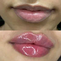 تخفیف ژل بوتاکس مزوژل