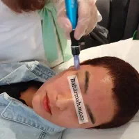 مزونیدلینگ صورت و اسکالپ سر