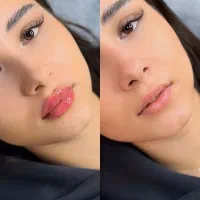 تخفیف تزریقات فیلر ، بوتاکس ، مزوژل (سجاد)