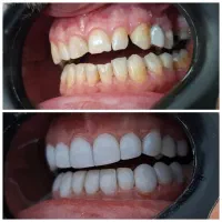کامپوزیت و عصب کشی و روکش دندانپزشکی