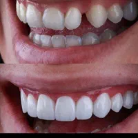 خدمات دندان پزشکی لمینت و کامپوزیت زیبایی