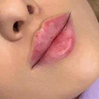 تزریق فیلر بوتاکس۳۴۹ لیزر زاویه متدmd codeمزوپزشک
