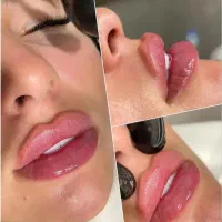 فیلر  بوتاکس  آنزیم با تخفیف ویژه