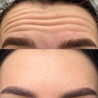 تزریق بوتاکس با قیمت مناسب و فرم دهی طبیعی و ظریف
