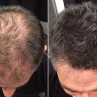 تا کی میخوای موهای کم پشت و ضعیف داشته باشی