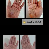 بدون رژیم سخت وبدون ورزش سخت لاغر شو