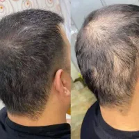 از جمع کچلا در بیا