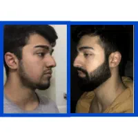 سرم ریش با فرمولاسیون ایتالیا((رویش و پرپشتی ریش))