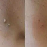 محلول از بین برنده زگیل،منگوله گوشتی و...