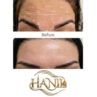 تزریق چربی رایگان (زیر نظر پزشک