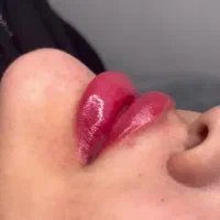 تزریق ژل و بوتاکس و prp صورت و مزو مو