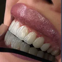 دندانپزشکی/کامپوزیت/50%تخفیف/دوفک 50م 36و۲۶