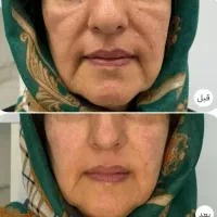 هیولای جوانسازی با بیوممتیک جدید اصل و اقتصادی