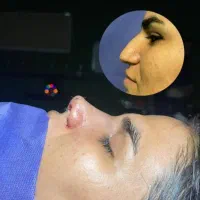 عمل بینی مدت اف محدوده ۴۵ملیون بیمارستان