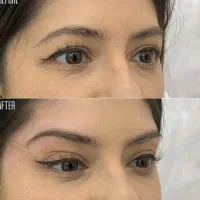 خدمات بوتاکس