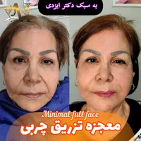 فیلر بادی، جراحی سرپایی زیبایی حجم دهی صورت بدن|خدمات آرایشگری و زیبایی|مرودشت, رودبال|دیوار