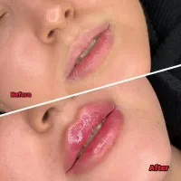 آف ویژه بوتاکس و .... توسط پزشک