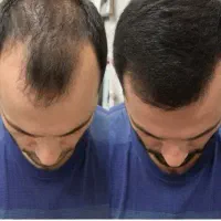 ریزش موهات قطع میشه واسه همیشه