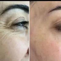 مدل بوتاکس صورت  و جوان ساز