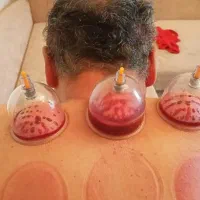 حجامت بادکش خدمات پرستاری تخصصی منزل