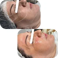 خدمات هایفو لیفت صورت
