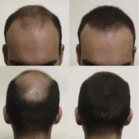 رفع طاسی و شروع رویش طبیعی