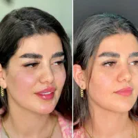 فیلرلب،ژل،چونه،پی ارپی،جوانساز|خدمات زیبایی و سلامت|کرج, جهان‌شهر|دیوار
