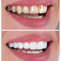 کامپوزیت دندان با تضمین ماندگاری + ویزیت رایگان