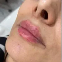 تزریق فیلر و جوانساز وprp