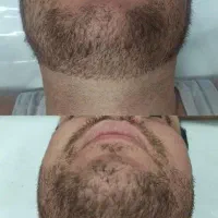 جشنواره‌لیزرموهای‌زائد،هایفو،کربن ویژه ماه محرم