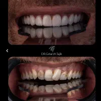 بیلیچینگ دندان برزیلی آف ویژه