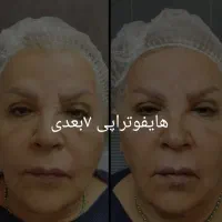 هایفو جوانسازی نتیجه قطعی با پایین ترین قیمت