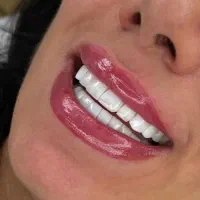 کامپوزیت دندان در محل شما