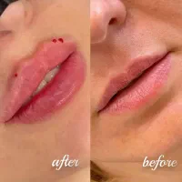 ژل و بوتاکس فیلر لیزر تخفیف استثنایی ۶۰ درصدی