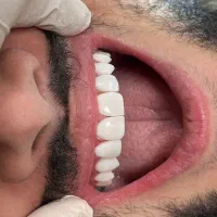 کامپوزیت ونیر اقساطی لبخند هالیوودی با شرایط ویژه