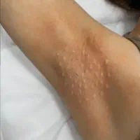 تخفیف بینظیر بوتاکس مصپورت زیربغل