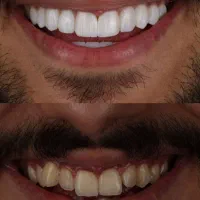لمینت متحرک دندان