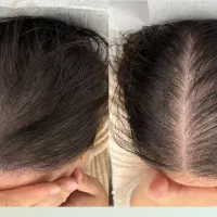 کیت خارجی برای پر پشت شدن مو