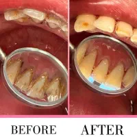 جرمگیری دندان با هزینه فقط۱۹۰تومان