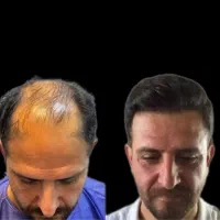 حرفه ای ترین تیم کاشت مو ریش و ابرو