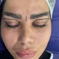 لیفت صورت با خواب مصنوعی ۷۰/ جراحی بینی ۳۵