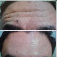 زیبایی به سبک اصفهان ،بوتاکس،فیلر وچربی توسط پزشک