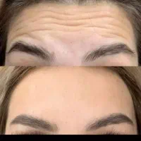 بوتاکس مصپورت و ژل توسط پزشک انجام میشه