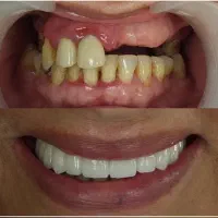 مرکزفوق تخصصی ایمپلنت دیجیتال/فوری/سبک کاخ لبخند