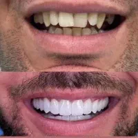 کامپوزیت جنس درجه یک با قیمت مناسب