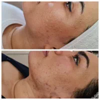 فیشال صورت