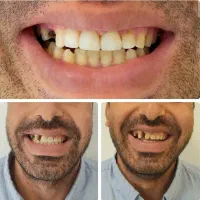 دندانپزشک‌عمومی‌وزیبایی‌دربوکان.ایمپلنت،کامپوزیت..
