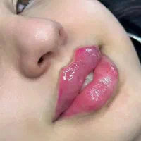 ژل لب و بوتاکس سی‌سی 700 کلینیک