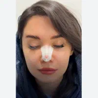 خدمات مربوط به بعداز عمل رینوپلاستی