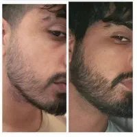 دیگه سمت کاشت مو نرو